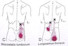 A5.7.Cơ chậu sườn ngực-Cơ ngực dài-Iliocostalis_lum-Longissimus_thora