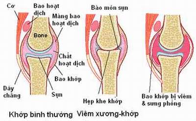 THOÁI HÓA KHỚP GỐI