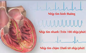 NHỊP TIM NHANH