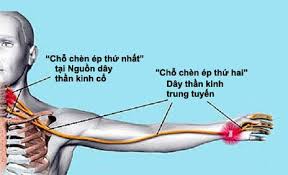 Đau cổ tay giống như ống cổ tay