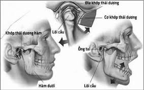 Đau khớp thái dương hàm