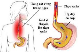 Viêm thực quản trào ngược