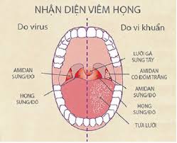 Viêm Họng