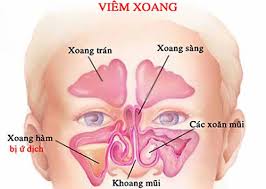 Đau má (như viêm xoang)