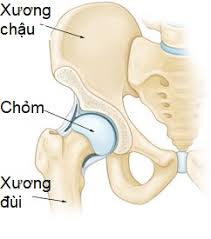 HOẠI TỬ VÔ KHUẨN MỎM XƯƠNG ĐÙI